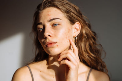 The Best Skincare Products for Acne Prone Skin